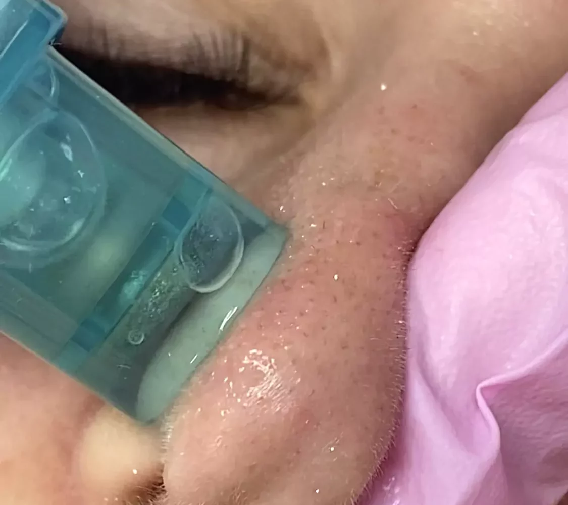 Completing a hydrofacial in Bourbonnais