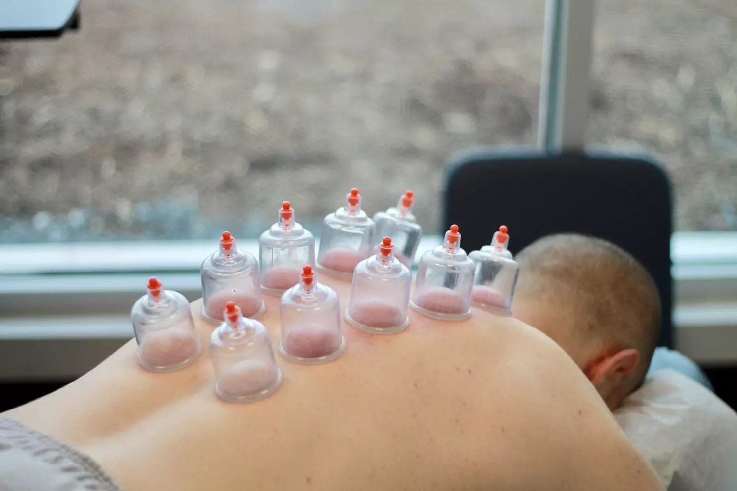 Myofascial Cupping Therapy in Bourbonnais
